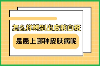 白癩風(fēng)患者運(yùn)動(dòng)改善體質(zhì)，同時(shí)這些事項(xiàng)注意不能缺少